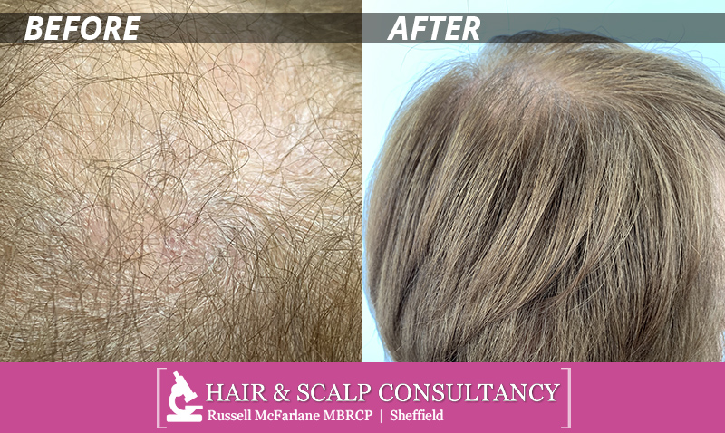 Hair & Scalp Consultancy before & after